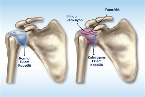 omuz ekleminin osteoartritinde ağrı nasıl giderilir